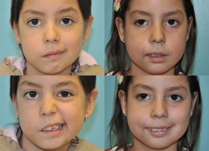 pediatric facial facial