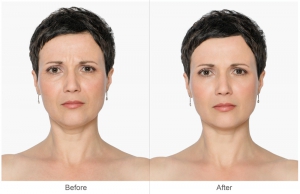 Nasolabial Folds and Marionette Lines