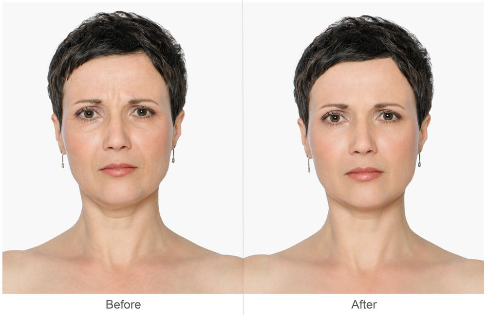 Botox and Fillers in Lahore Pakistan