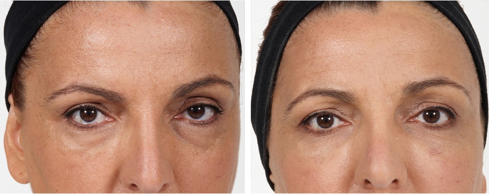Botox and Fillers Lahore Pakistan