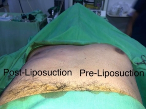 Liposuction by Dr Sheraz Raza