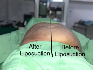 Liposuction by Dr Sheraz Raza