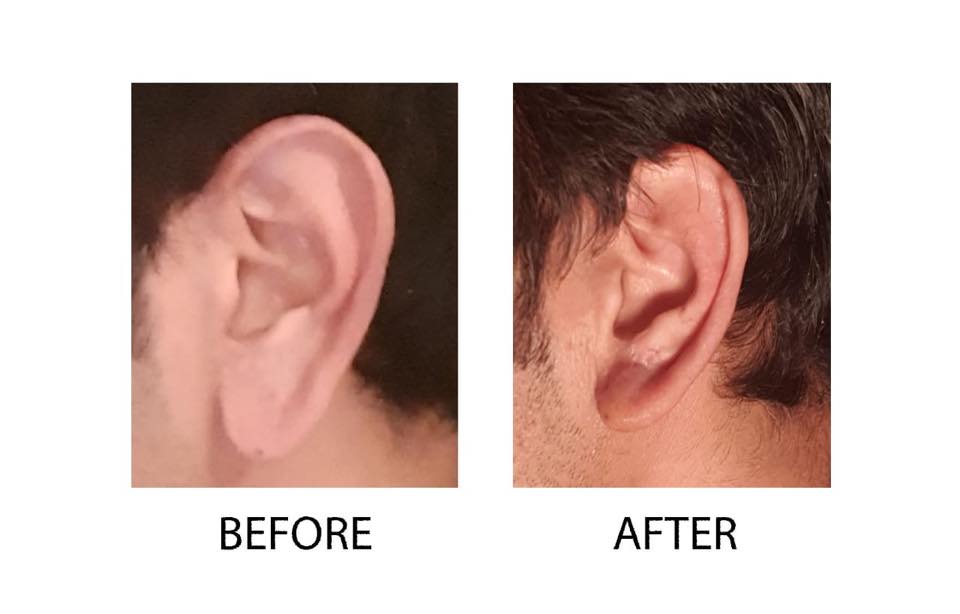 ear-lobe-correction-sheraz-plastic-surgery