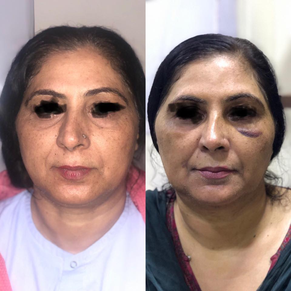 Reshape The Forehead Sheraz Plastic Surgery 2112