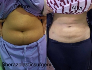 Dr Sheraz Raza Liposuction Surgeon