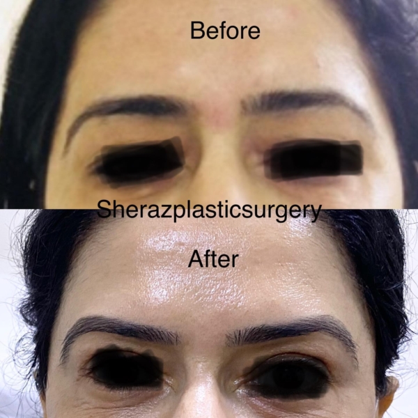 Dr Sheraz Raza Browlift Sheraz Plastic Surgery 7775