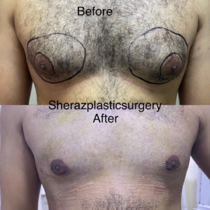 Dr Sheraz Raza Breast Reduction