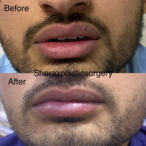 Dr Sheraz Raza Lips Reduction