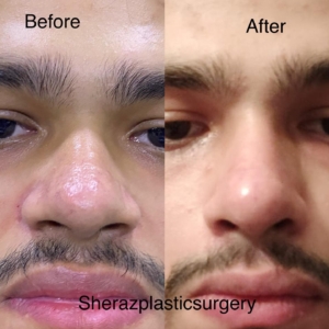 Dr Sheraz Raza Rhinoplasty Surgeon