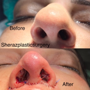 Dr Sheraz Raza Rhinoplasty Surgeon