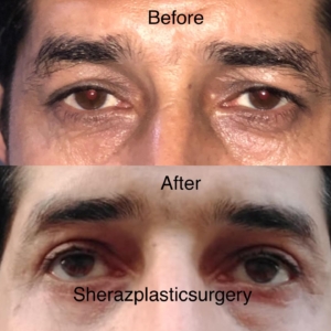 Dr Sheraz Raza upper eyelid